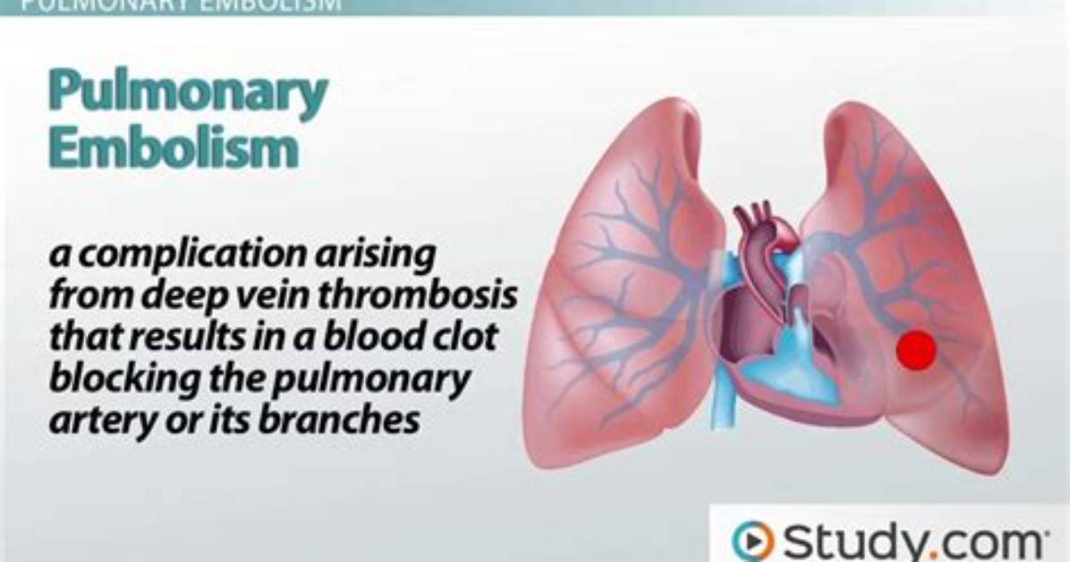 Where Does Embolism Occur?