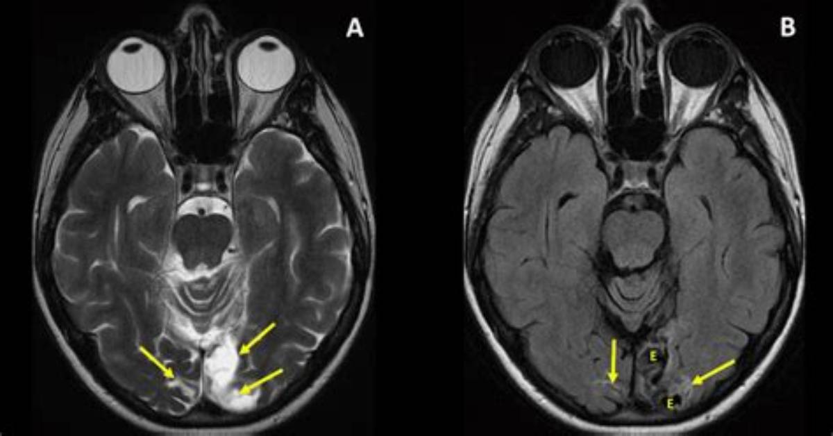 Where Does Encephalomalacia Come from?