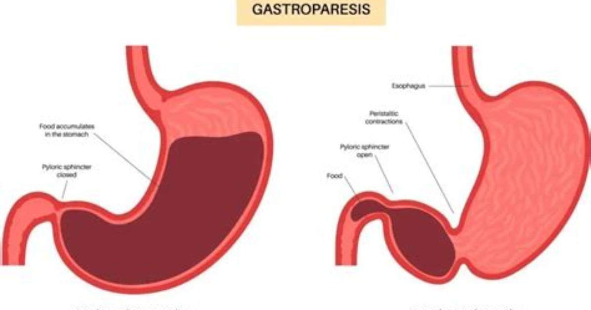 Where Does Gastroparesis Occur?