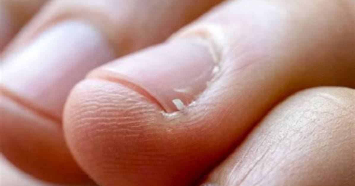 Where Does Hangnails Come from?