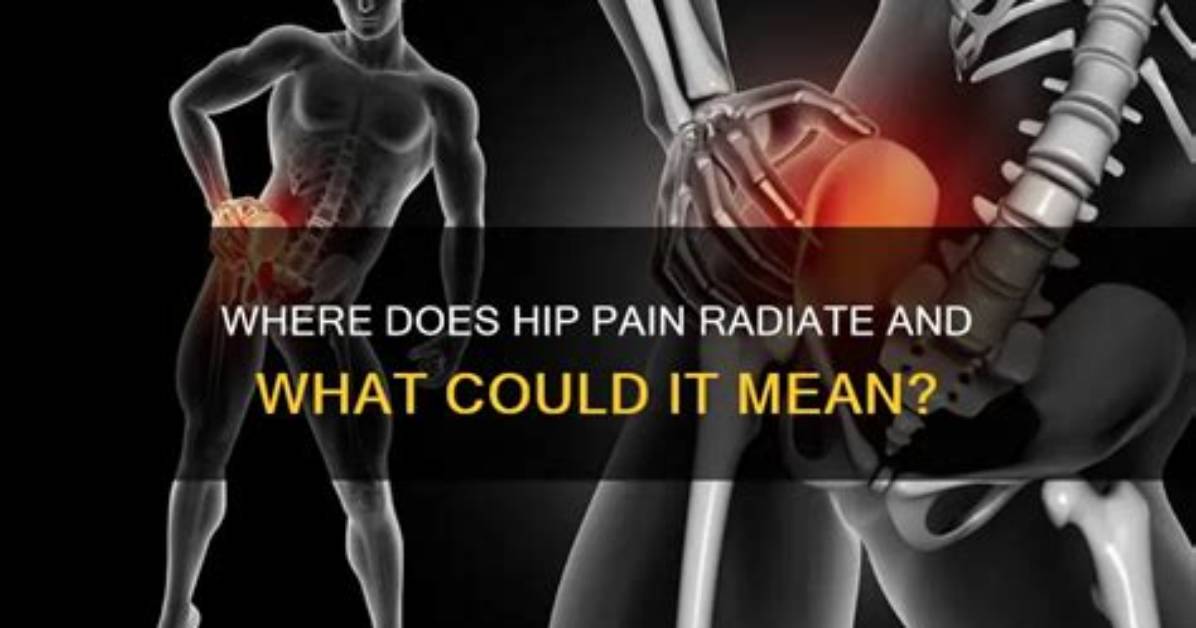 Where Does Hip Pain Radiate?
