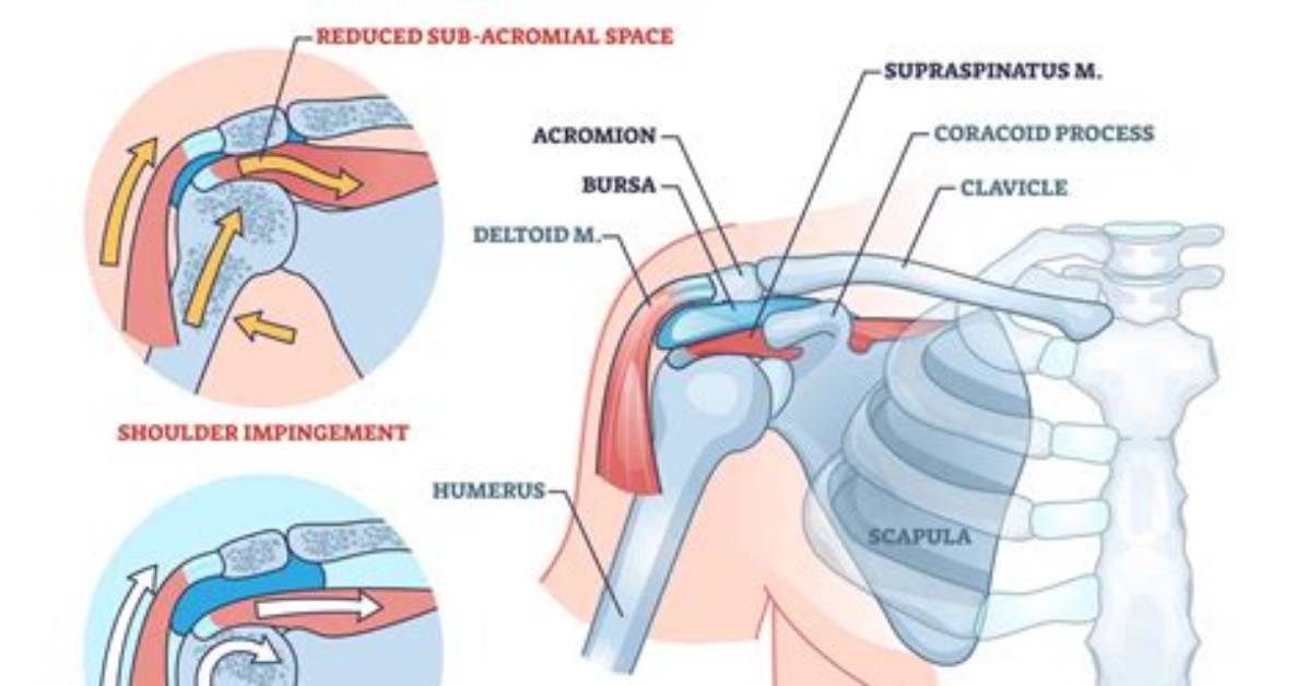 Where Does Impingement Hurt?