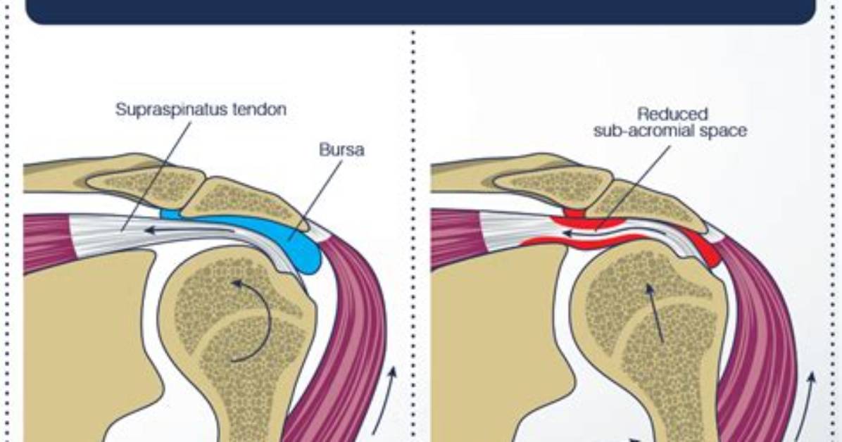 Where Does Impingement Occur?