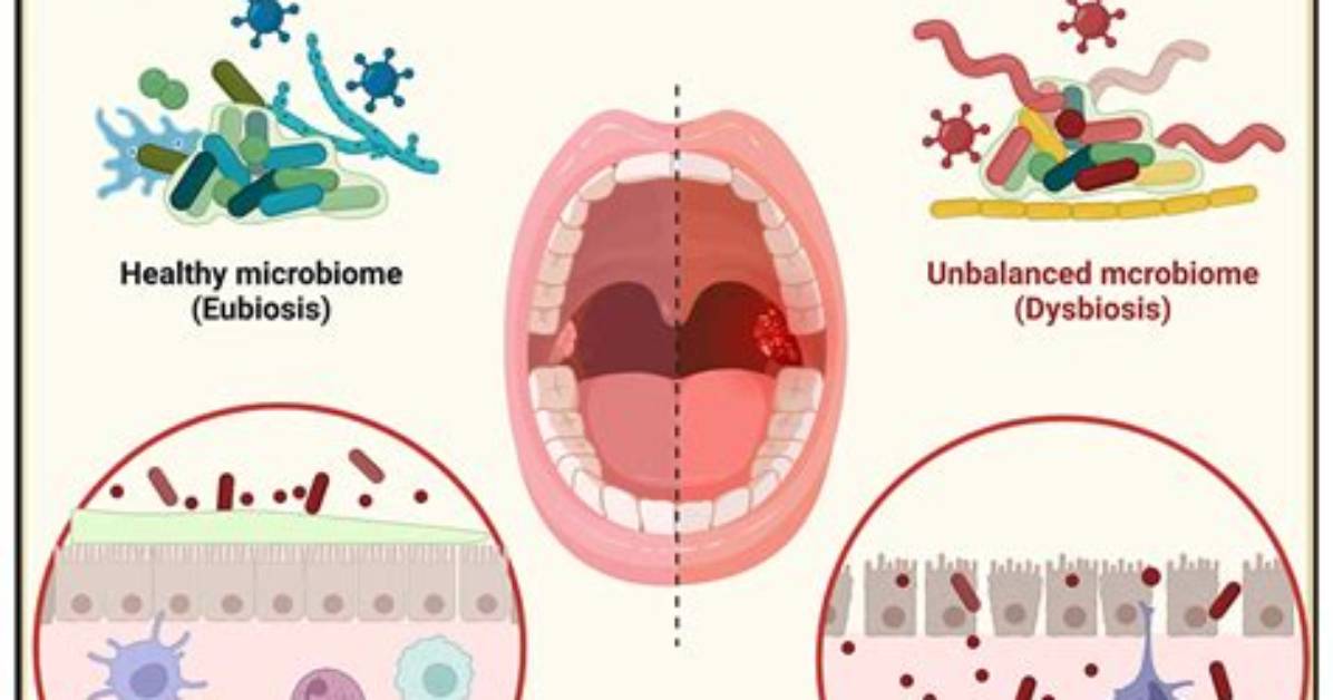 Where Does Microbiome Imbalance Occur?