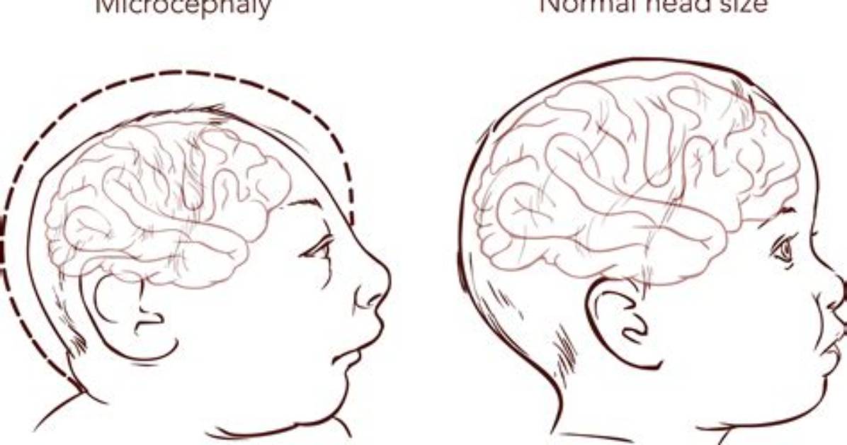 Where Does Microcephaly Originate from?