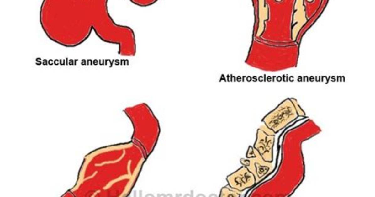 Where Does Mycotic Aneurysm Occur?