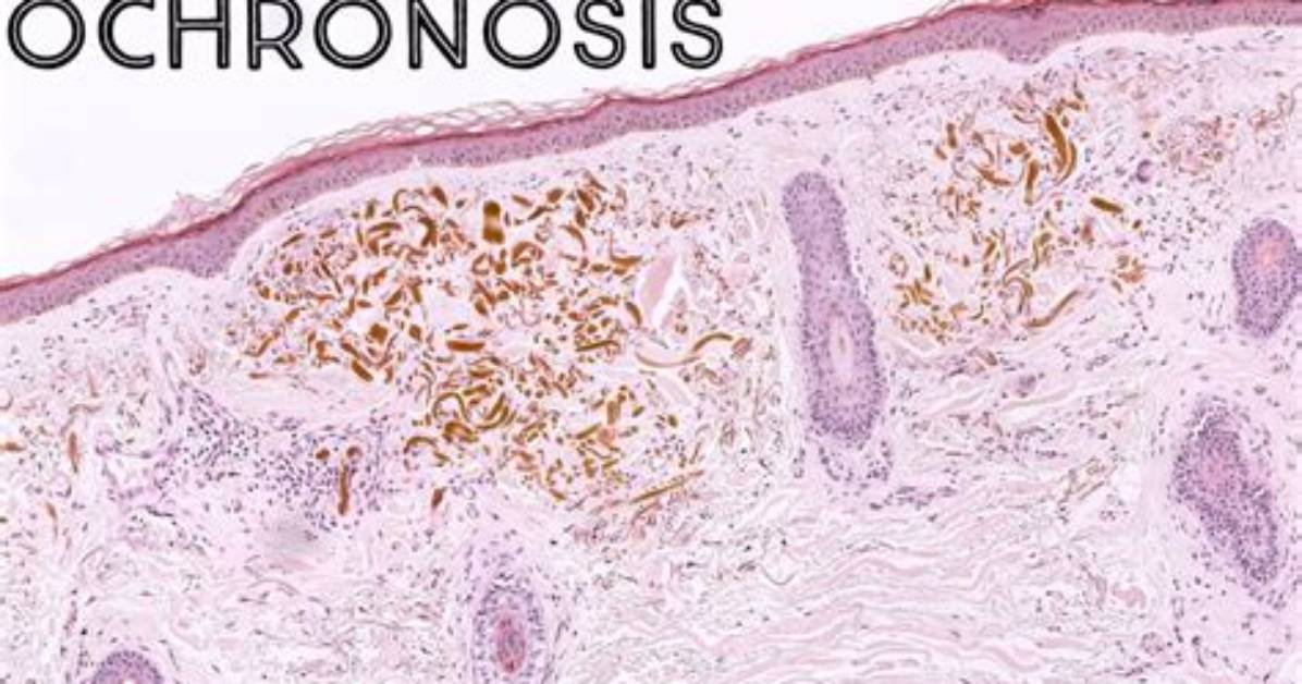 Where Does Ochronosis Occur?