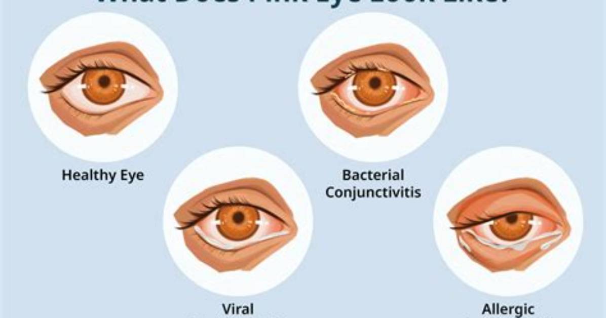 Where Does Pink Eye Come from?