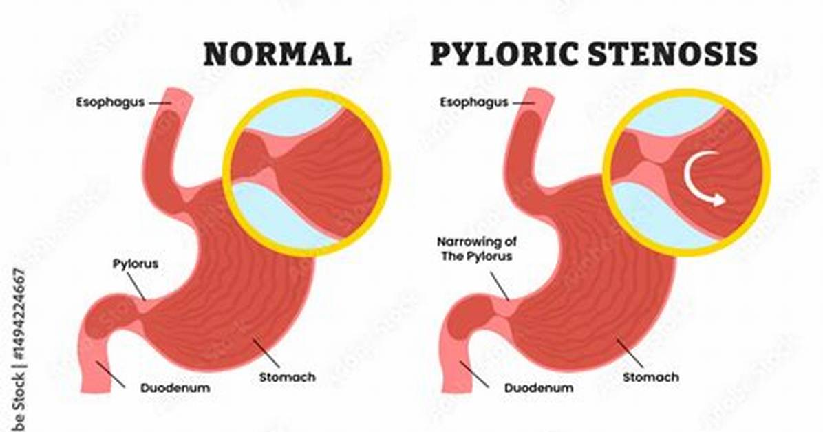 Where Does Pyloric Stenosis Occur?