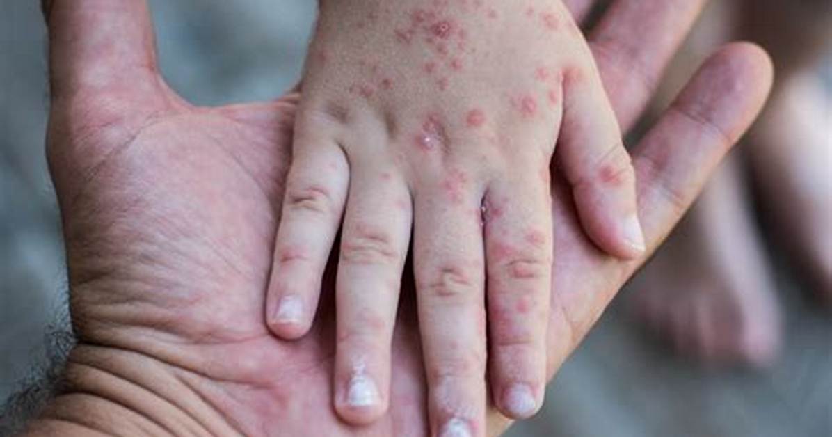 Where Does Rubella Exist