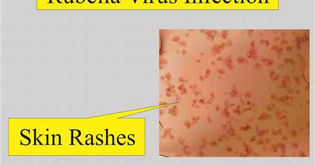 Where Does Rubella Infect