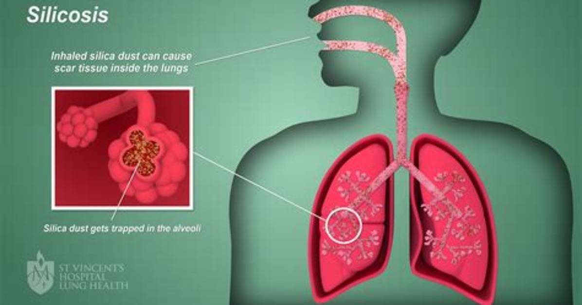 Where Does Silicosis Come from?