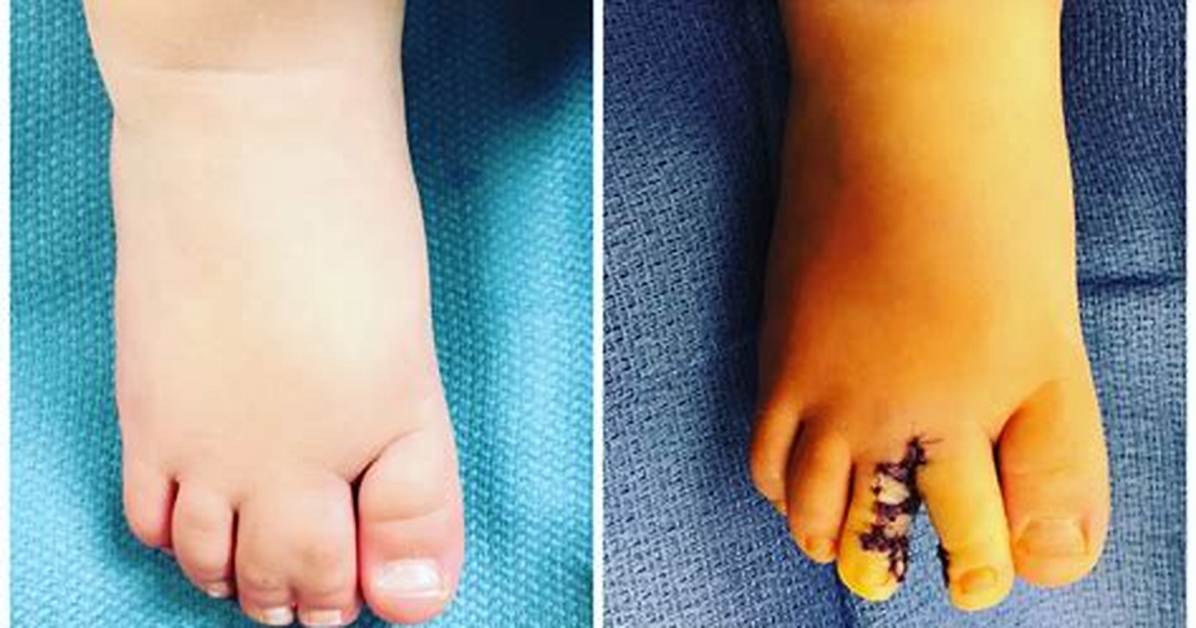 Where Does Syndactyly Occur?