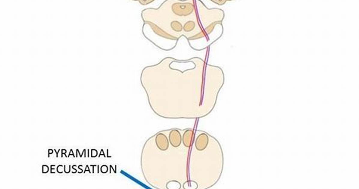 Where Does the Pyramidal Tract Decussation