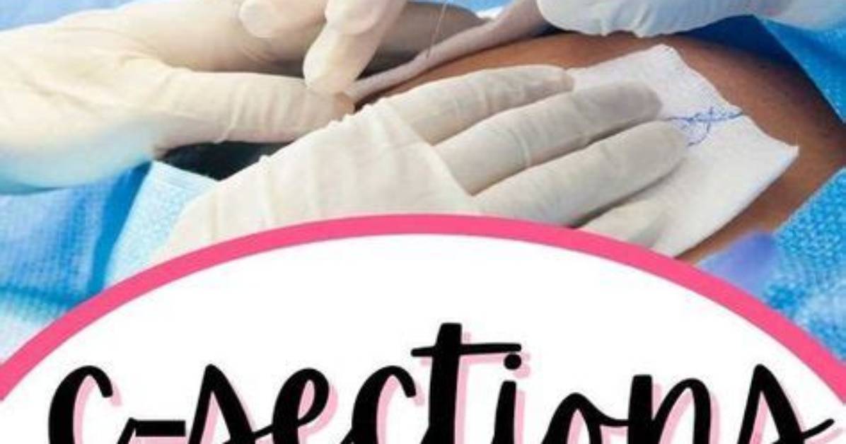 Where Does the Word C Section Come from?