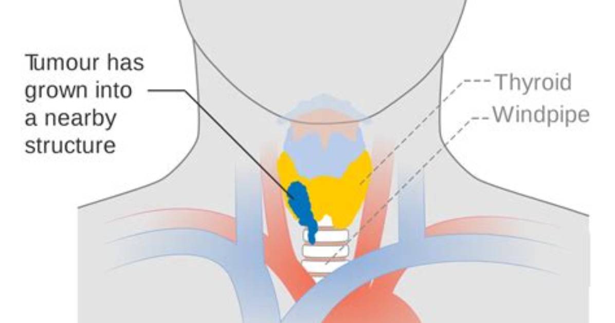 Where Does Thyroid Cancer Spread to First?