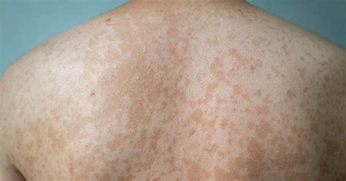 Where Does Tinea Versicolor Come from?