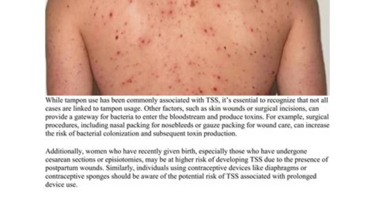 Where Does Tss Rash Start?