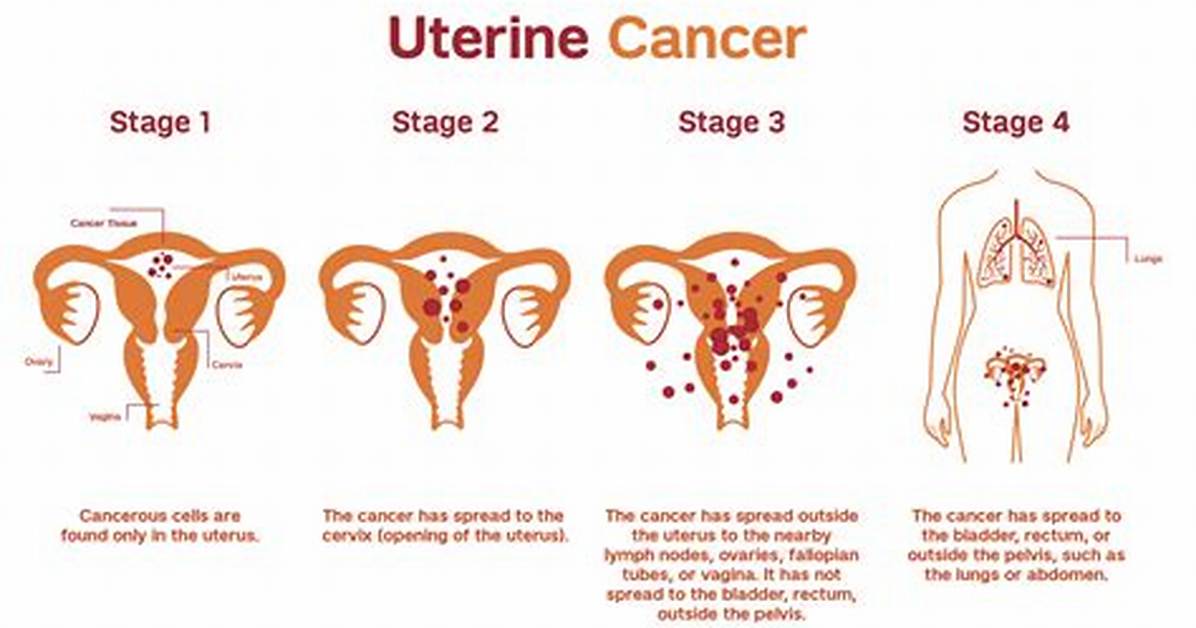 Where Does Uterine Carcinosarcoma Spread to?