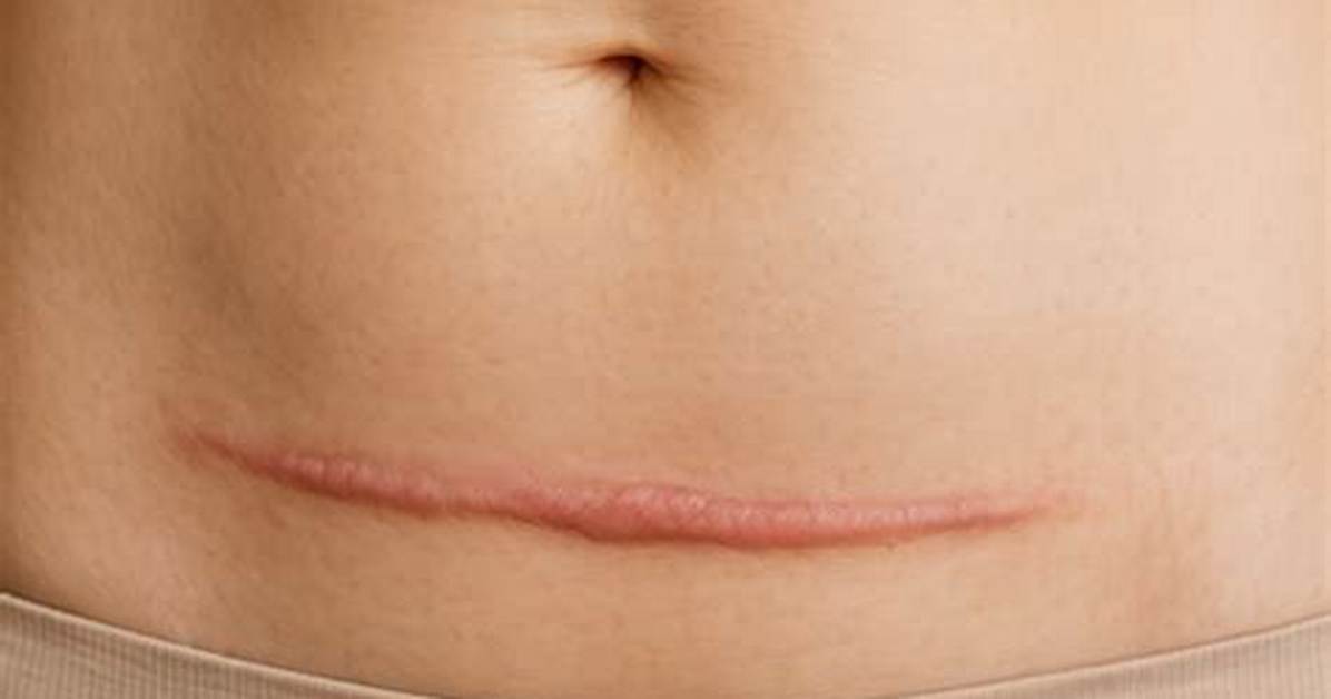 Where Is a C Section Scar?
