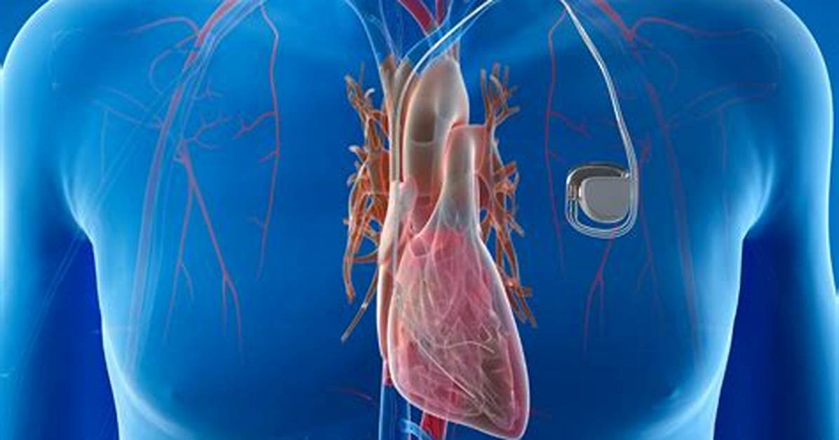 Where Is a Pacemaker Fitted?