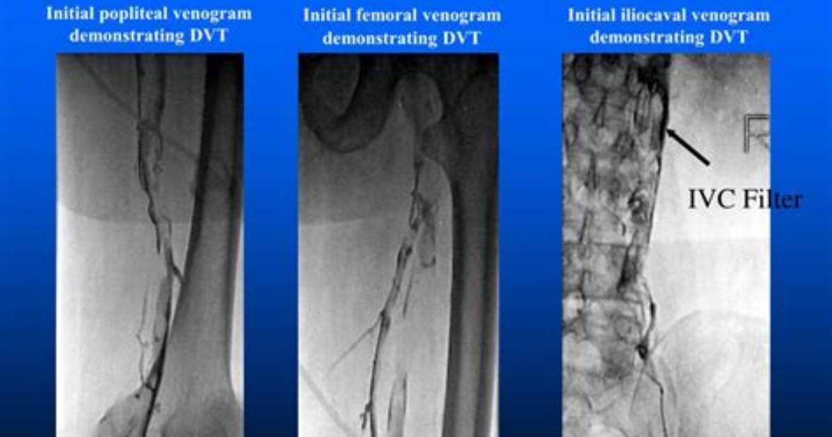 Where Is a Venogram Done?