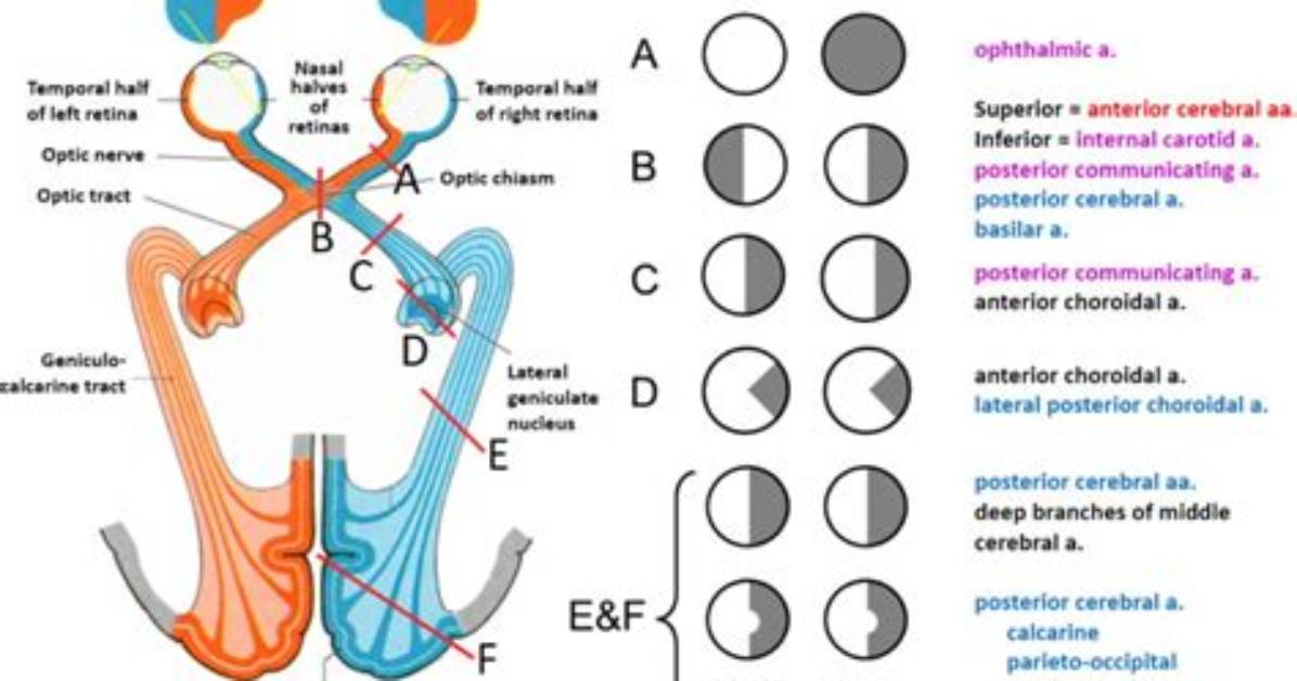 Where Is Bitemporal Hemianopia?
