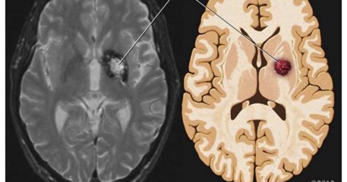 Where Is Cavernous Malformation?