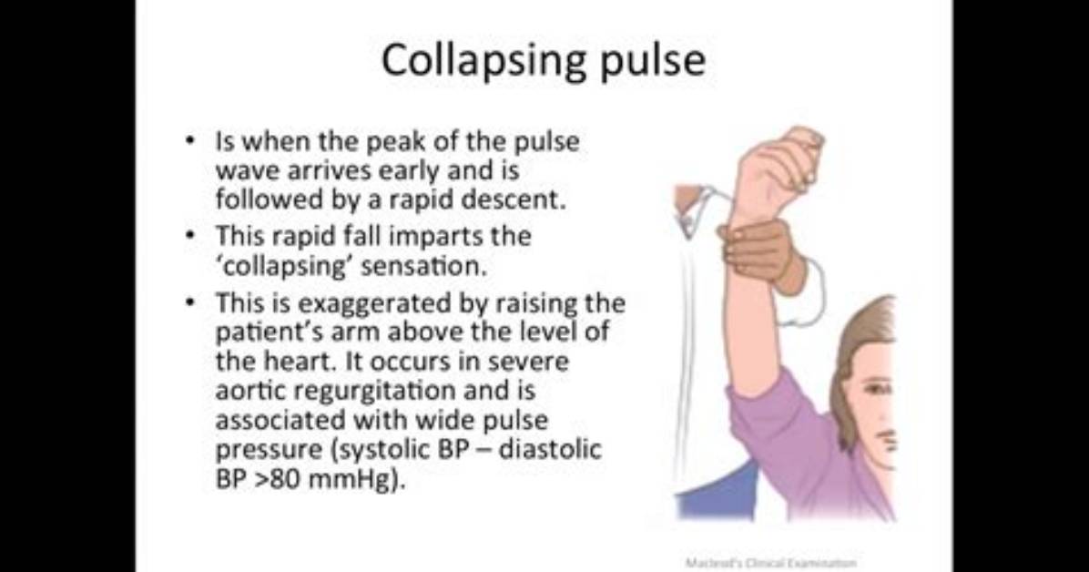 Where Is Collapsing Pulse?