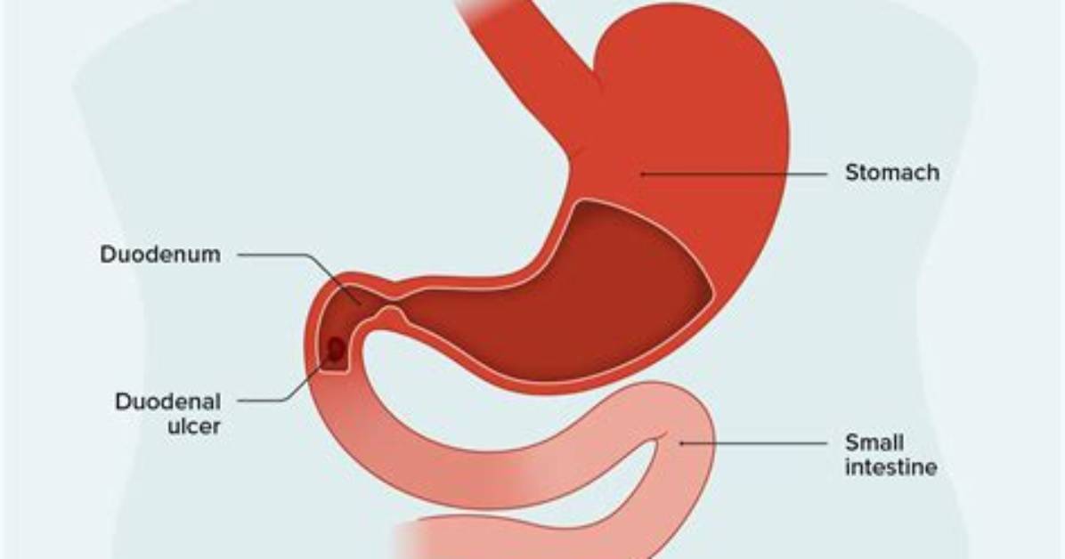 Where Is Duodenum Pain Located?