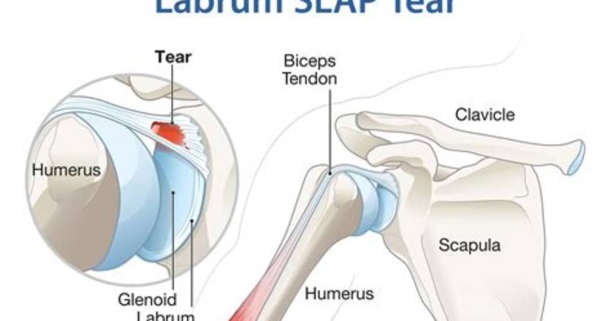 Where Is Labrum Pain?