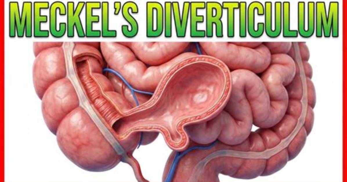 Where Is Meckel's Diverticulum?