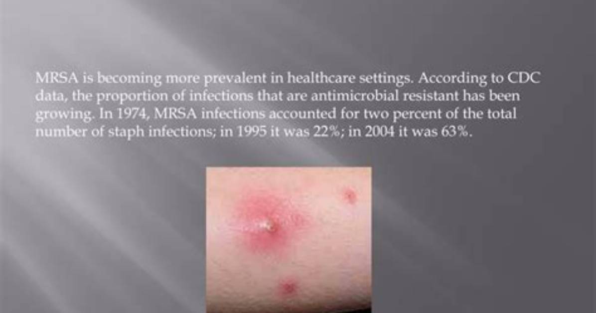 Where Is Methicillin-Resistant Staphylococcus Aureus Found?