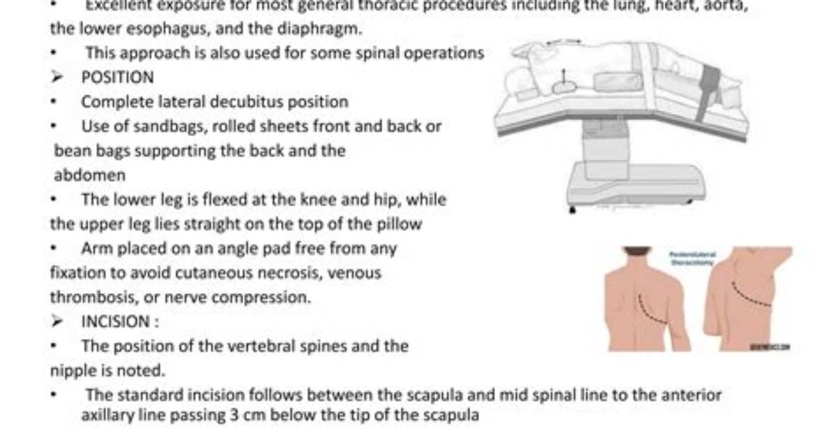 Where Is Posterolateral Thoracotomy?