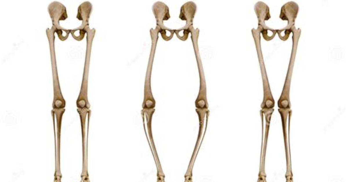Where Is Rickets Most Common?