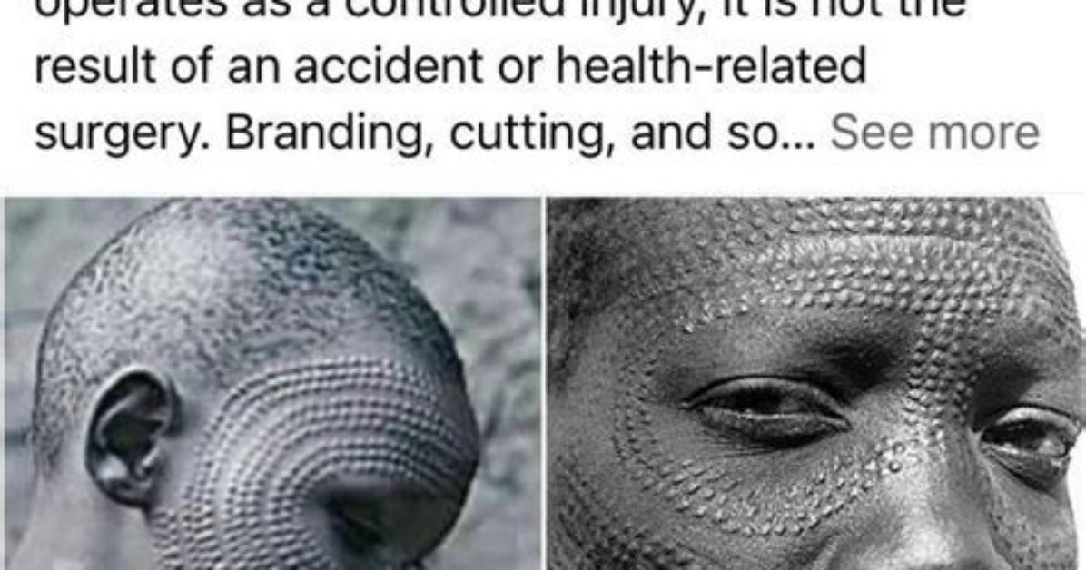 Where Is Scarification Located