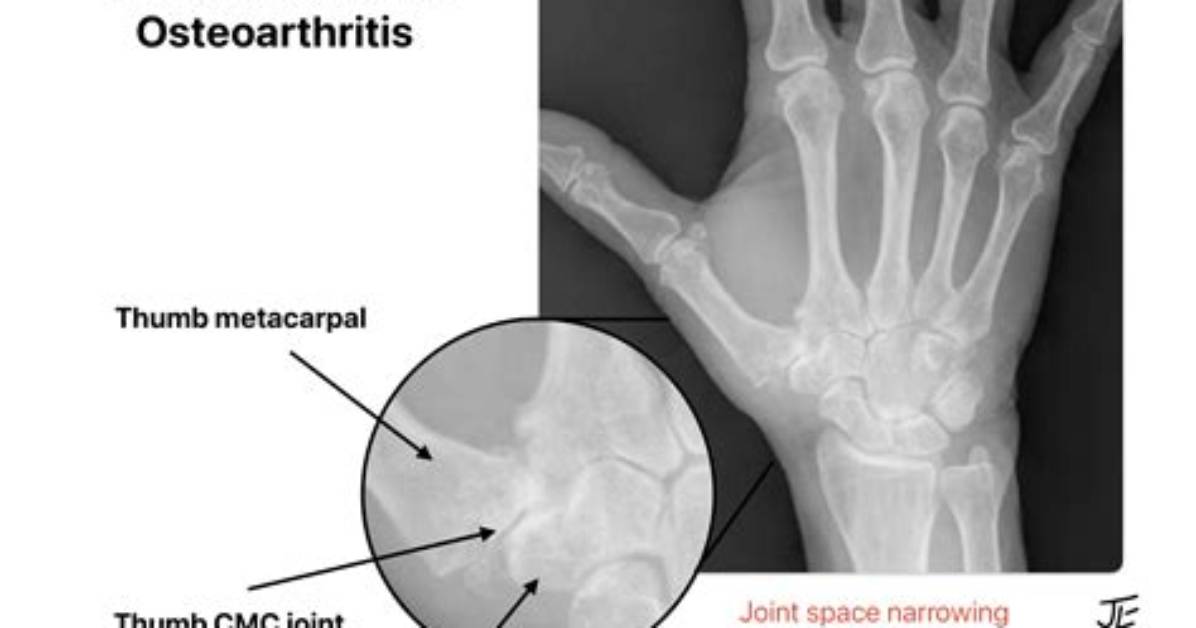 Where Is the Cmc Joint?