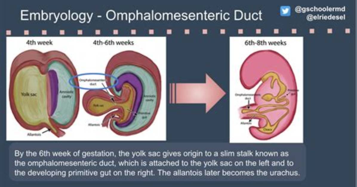 Where Is the Omphalomesenteric Duct Located?
