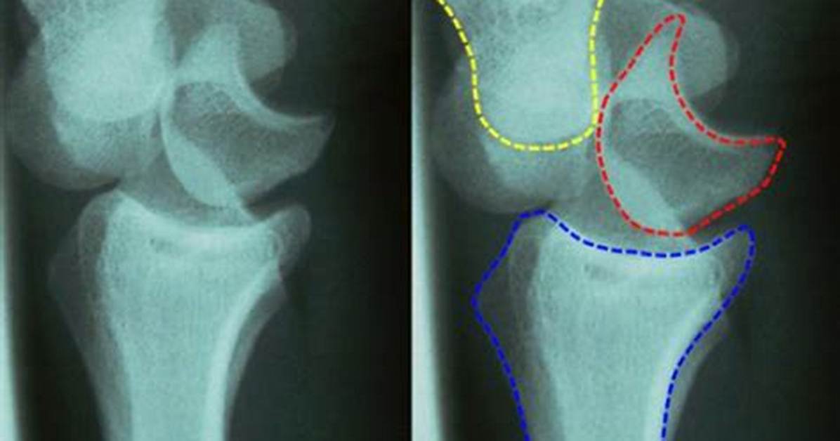 Where Is the Perilunate Dislocation