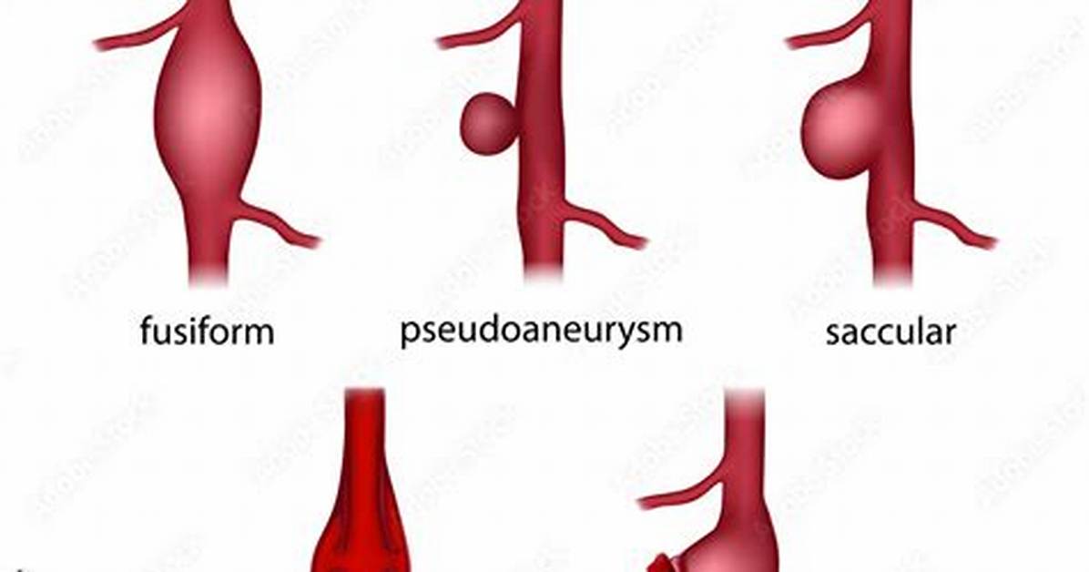 Where Is the Saccular Aneurysm?