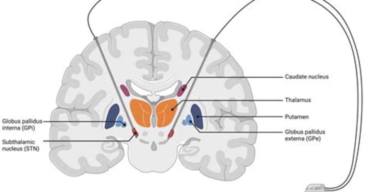 Where Is the Subthalamic Nucleus?