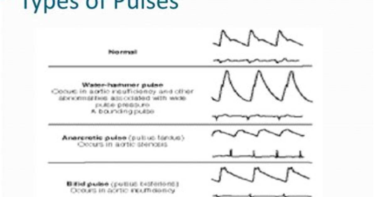 Where Is Thready Pulse?