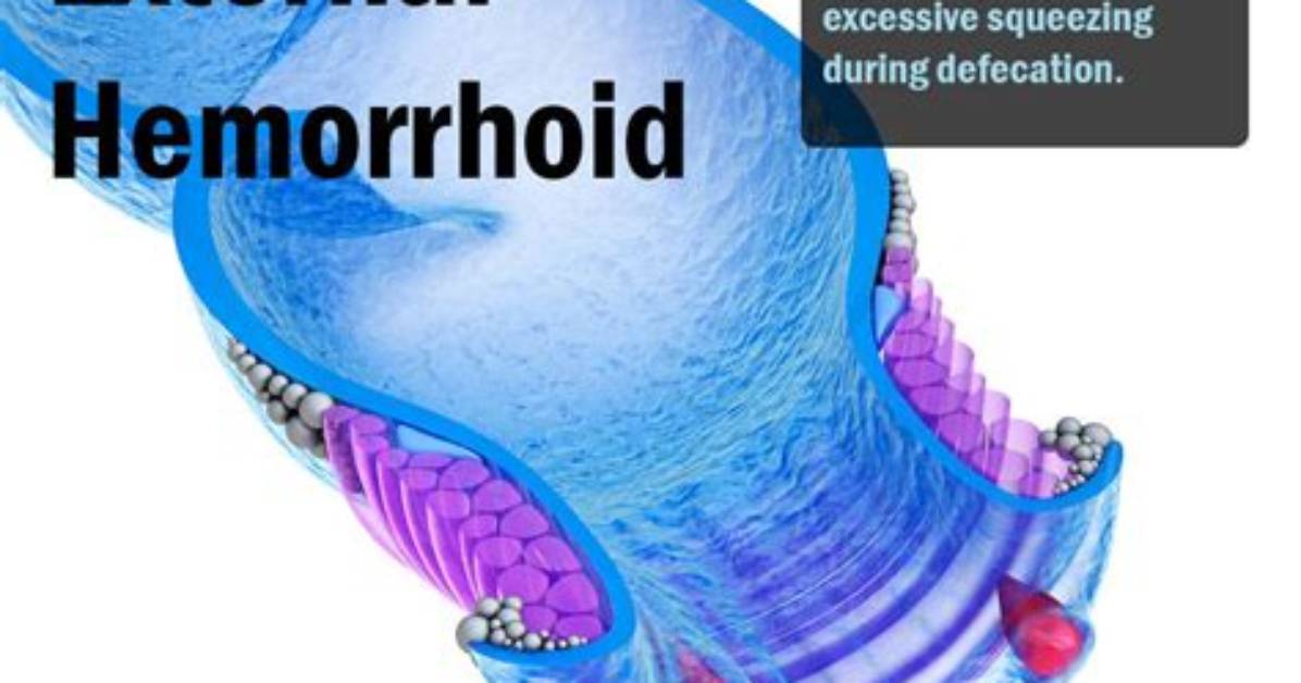 Where Is Thrombosed Located?