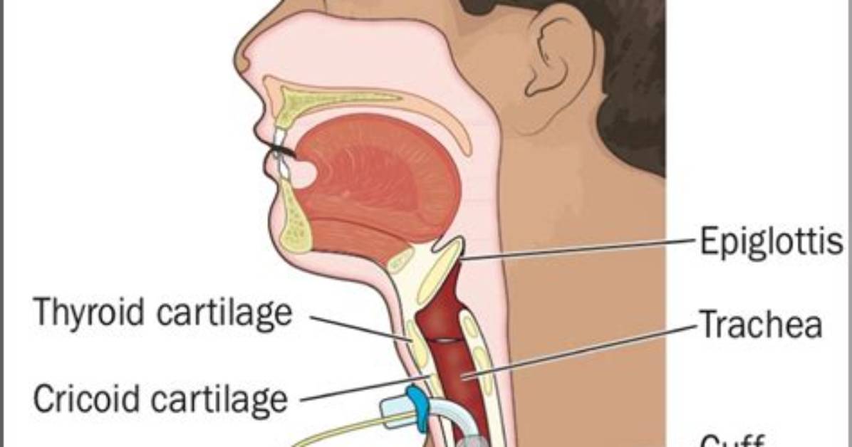 Where Is Tracheostomy Done?