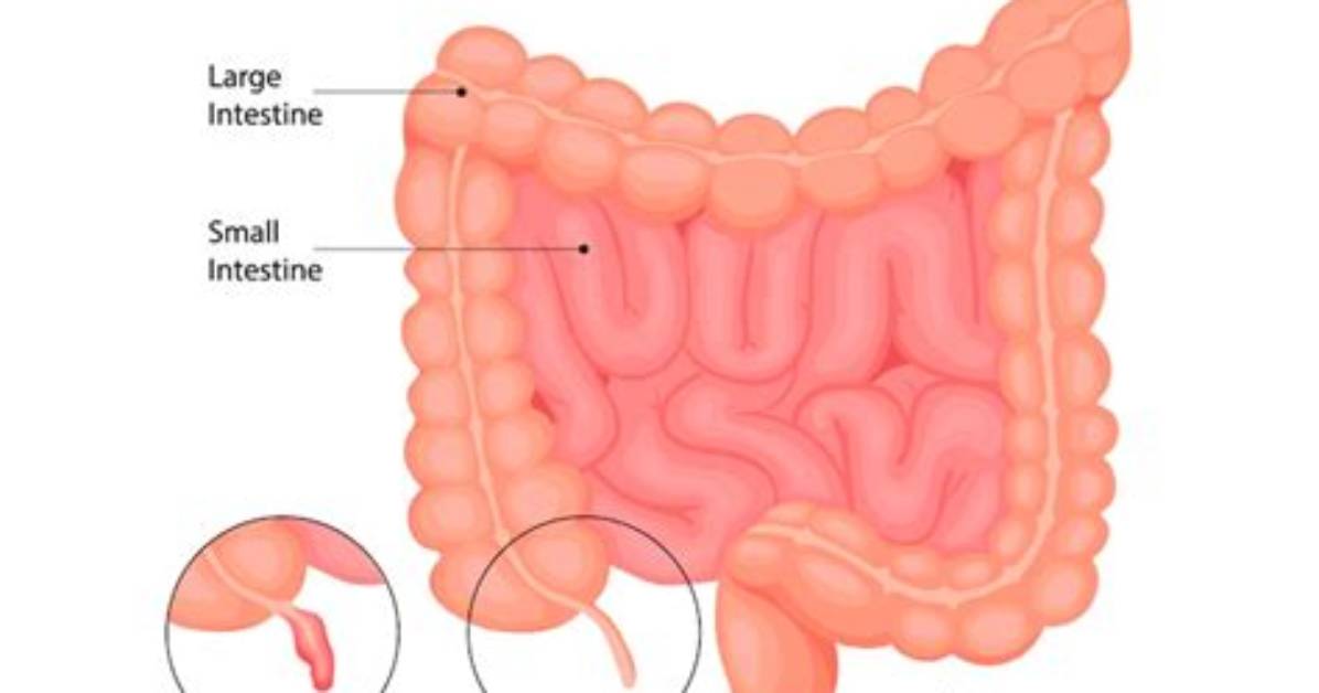 Where Is Your Appendix Located on a Female
