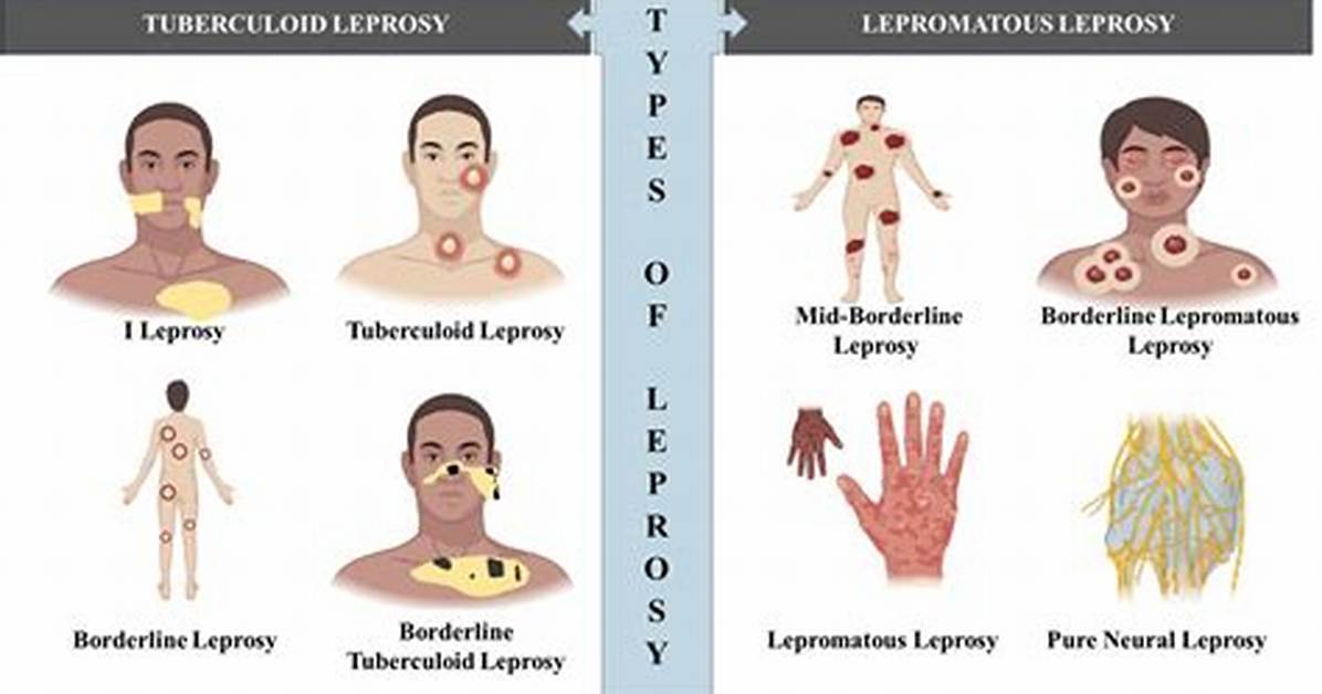 Where Leprosy Come from?