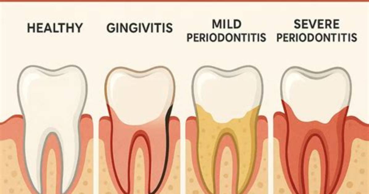 Where Periodontitis Come from?