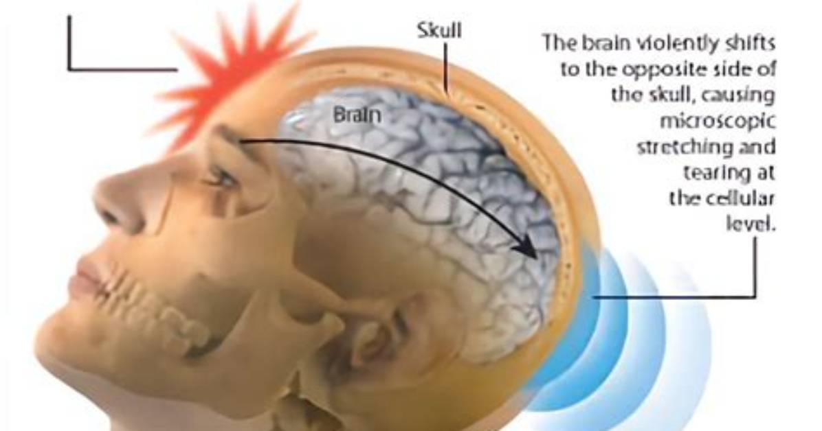 Which Caused a Concussion?