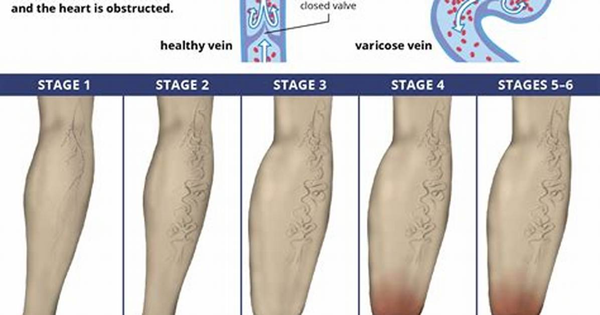 Which Chronic Venous Insufficiency?
