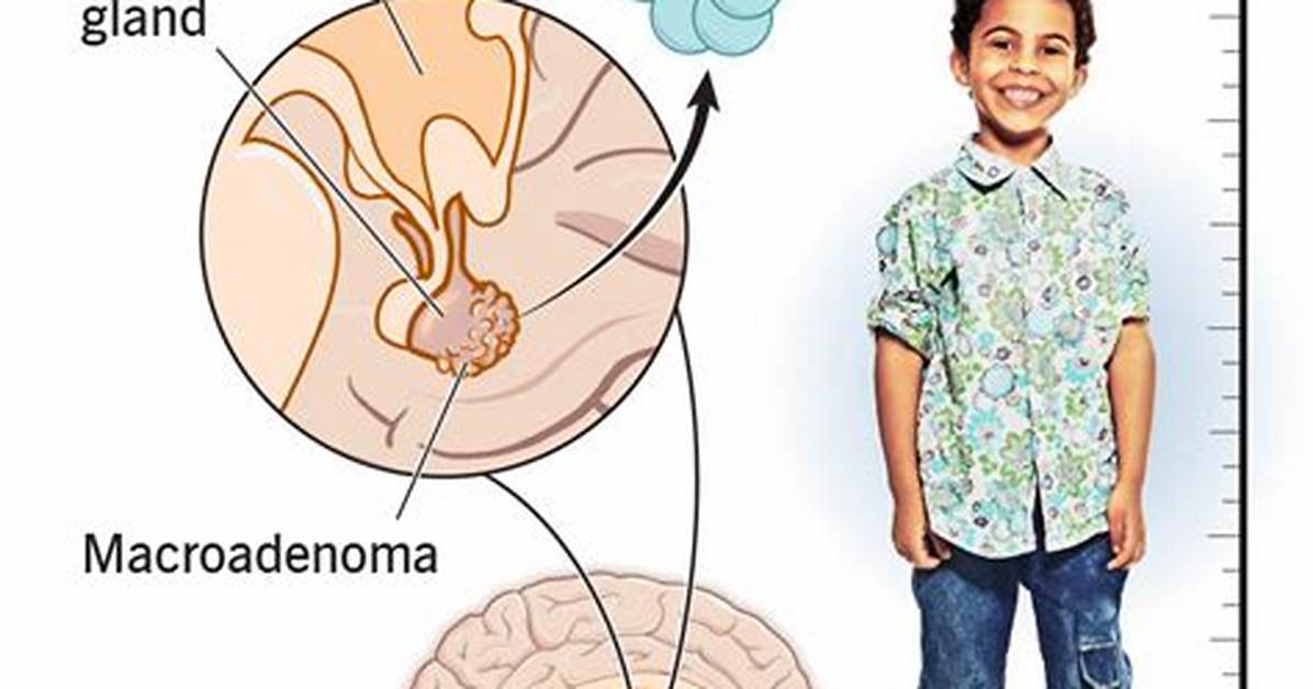 Which Hormone Causes Gigantism?
